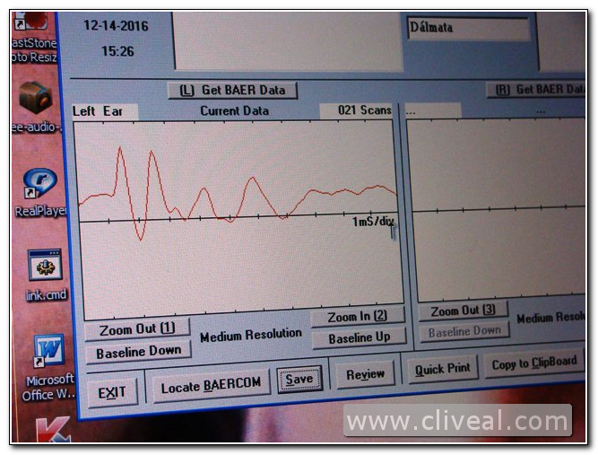diagrama audicion oido izquierdo